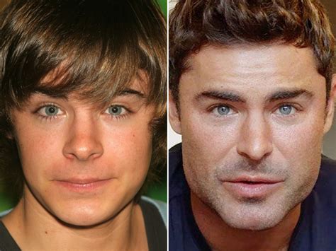 zac efron before and after surgery.